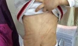 Bé trai 9 tuổi bị cha mẹ nuôi hành hạ dã man