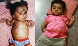 Cô gái mắc bệnh lạ 19 tuổi vẫn như trẻ lên 2