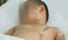 Nỗi đau hai mẹ con bị kẻ hận tình tạt axit