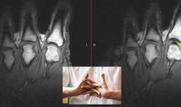 Bẻ khớp ngón tay có gây nguy hiểm cho sức khỏe?