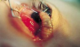 Những hình ảnh khủng khiếp về ký sinh trùng trên cơ thể người