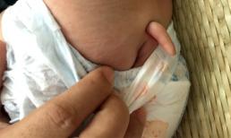 Kỳ lạ bé gái 7 tháng tuổi mọc ‘đuôi’ ở Bến Tre