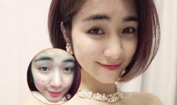 'Bạn gái' Công Phượng lộ mặt mộc đầy mụn và vết thâm