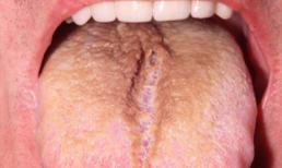 Những bí mật của lưỡi bật mí tình trạng sức khỏe của bạn