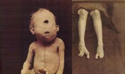 Những hình ảnh đáng sợ trong lịch sử ngành y mà bạn chưa biết?