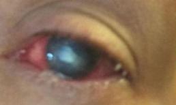 Bị ký sinh trùng ăn giác mạc vì muốn làm đẹp 