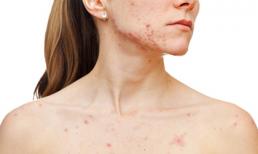 Bất ngờ với cách xóa mụn 'siêu nhanh'