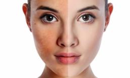 Bật mí cách phòng và điều trị nám da ngày hè oi ả