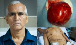 Phát hiện khối u thận to bằng quả dưa hấu 