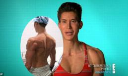 Chàng trai 'búp bê sống' phẫu thuật lần thứ 191 để lắp thêm cánh