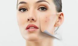 Bí quyết 'thổi bay' mụn khi hè đến