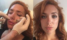 Cận cảnh quá trình tiêm môi căng mọng như Angelina Jolie