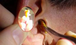 Ghê rợn với cục ráy tai to bằng cây nến nhỏ