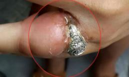 Ghê rợn ngón tay bị viêm nhiễm do đeo nhẫn quá chật