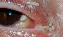 Ghê rợn giòi bò lổm ngổm trong mắt và hốc mũi