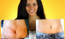 Tự tin với làn da không còn vết rạn