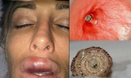 Cô gái sưng vều môi vì bị giòi ký sinh bên trong 