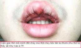 Chàng trai Hà Nội chịu đau đớn 'chết đi sống lại' để thẩm mỹ môi trái tim