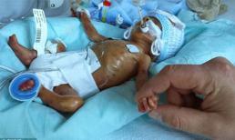 Cảm động với hành trình chuyển biến diệu kỳ của em bé sinh non 4 tháng tuổi