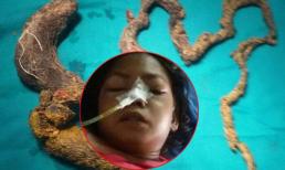 Kinh hãi búi tóc dài hơn 1,5 mét trong dạ dày cô gái 15 tuổi