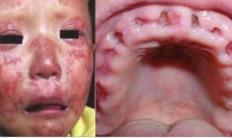 Cậu bé 5 tuổi vẫn không mọc răng 