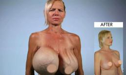 Ngực biến dị nặng 13kg vì bơm silicon