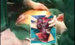 Cô gái trẻ 'thối ruột' vì uống thuốc giảm cân quá nhiều