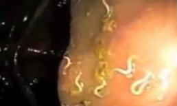 Rùng mình cảnh ký sinh trùng 'lúc nhúc' trong cơ thể người