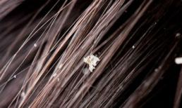 8 phương pháp độc đáo trị gàu ngày hè