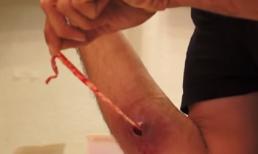 Rợn người giun sống ký sinh ở tay người