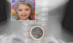 Bé gái 4 tuổi tử vong vì nuốt phải pin cúc áo 