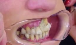 10 năm gắn răng vào lợi bằng keo dính vì sợ đi nha sĩ