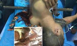 Chàng trai xém chết vì thanh sắt xuyên ngực cách tim 1cm