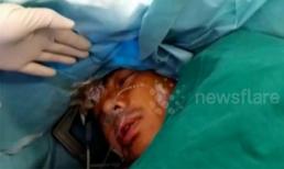 Bệnh nhân đọc thơ, nói chuyện khi đang mổ não