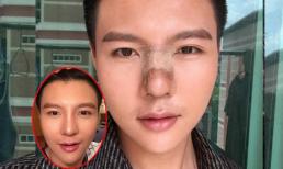 Chàng trai bất chấp đau đớn 5 lần phẫu thuật thẩm mỹ chỉnh mũi