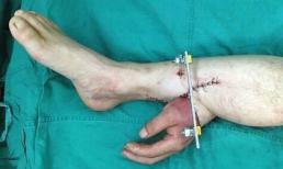 Bàn tay ghép dưới bắp chân lạ lùng