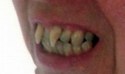 Người phụ nữ biến thành 'ma cà rồng' vì bệnh nướu răng