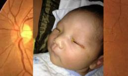 Em bé 3 tháng tuổi bị mù mắt vì đèn flash máy ảnh