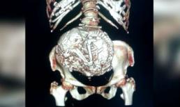 Phát hiện bào thai 60 năm trong bụng của cụ bà 91 tuổi