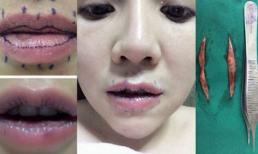 Những trường hợp làm đẹp với 'dao kéo' rùng rợn của giới trẻ