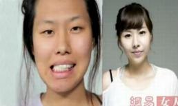  Vợ phẫu thuật thẩm mỹ đẹp khác thường sau khi bị chồng chê xấu đòi ly hôn