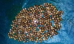 Phát hiện 360 viên sỏi trong túi mật người phụ nữ