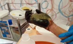 Người đàn ông phải cắt cụt tứ chi vì ngộ độc thực phẩm