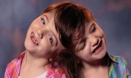 Cuộc sống thú vị của cặp song sinh dính liền đầu vào nhau