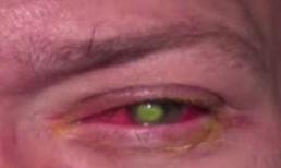 Người đàn ông bị mù vì đeo kính áp tròng đi ngủ