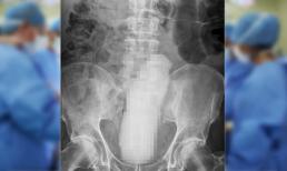 Cụ ông 68 tuổi bị mắc kẹt 'cậu nhỏ' giả dài 23cm ở ruột già