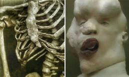 Khám phá bí ẩn về 'người voi'