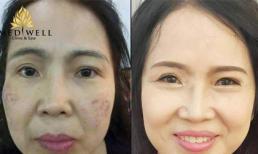 Lời khuyên của chuyên gia khi điều trị nám bằng Laser