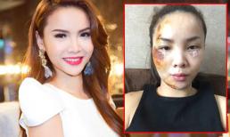 Yến Trang 'gây sốc' với gương mặt biến dạng vì tai nạn