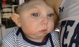 Cậu bé mất nửa hộp sọ bẩm sinh sống sót kỳ diệu